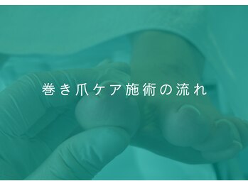 地爪ケアクリニックサロン 代々木店/巻き爪ケア施術の流れ