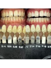 トウキョースワーズ 渋谷店(TOKYO SWRS)/#ホワイトニング #渋谷 #池袋