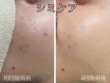 シエナ(ciena)/『シミケア4回』症例写真♪