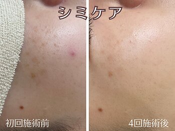シエナ(ciena)/『シミケア4回』症例写真♪
