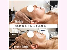 リンド(Lindo)/3D筋膜ストレッチ小顔術