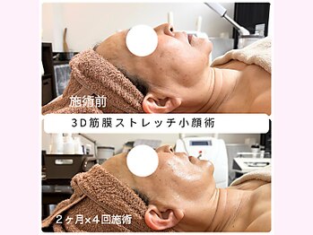 リンド(Lindo)/3D筋膜ストレッチ小顔術