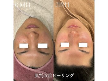 リベルキョウト 京都駅前店(Liber Kyoto)/肌質改善ピーリング