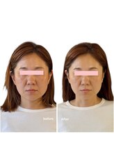 ニコディア(nico-dia)/美容鍼