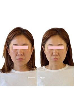 ニコディア(nico-dia)/美容鍼