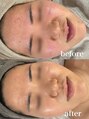リジュ(Reje) 担当させていただいた20代女性。1ヵ月の変化