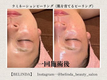 ベリンダ(BELINDA)/ラミネーションピーリング(肌育)