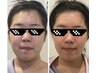 【小顔ケア】なんか顔スッキリした？を目指す♪水素フェイシャル＋炭酸パック