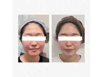 ウォーマル(warmaL)/小顔矯正/土台を整え真の小顔に