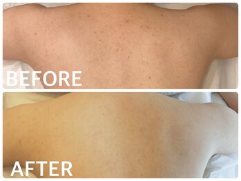 ハーブピーリング 心斎橋/背中ニキビ改善