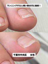 巻き爪じゅん 千葉駅前店/巻き爪の痛み改善へ