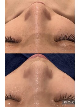 シャルム(CHARME)/セルマン前処置