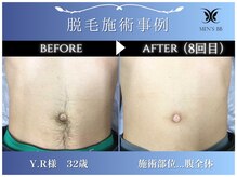 メンズビービー 福井高柳店(MEN'S BB)/ボディ脱毛施術事例