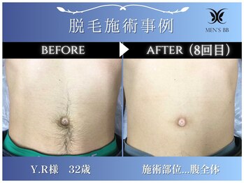 メンズビービー 福井高柳店(MEN'S BB)/ボディ脱毛施術事例