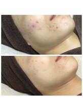 リラーナ(Re rana)/繰り返すニキビに◎