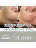 【お試し】生活習慣の乱れによる黒ずみ毛穴やニキビケアに/ハーブピーリング