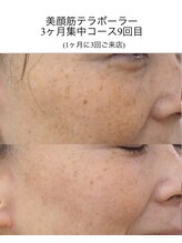 ベルフィーヌ ノーブル(BELLEFINE noble)/美顔筋テラボーラー即効小顔