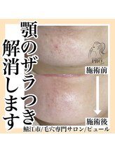 ピュール 鯖江店(PUR)/毛穴/毛穴ケア/毛穴洗浄