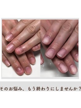 ティアラネイル 宇都宮/深爪矯正