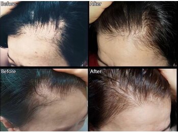 マーブル 熊本合志店/育毛促進【30代女性】