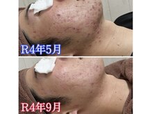 ベック(BECK)/人気なビームフェイシャル