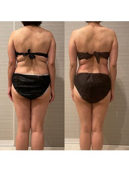 ギャラクシービューティー(galaxy beauty)/高周波痩身