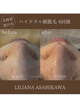 リリアーナ アサヒカワ(LILIANA ASAHIKAWA)/ハイドラ毛穴洗浄＋顔脱毛