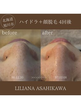 リリアーナ アサヒカワ(LILIANA ASAHIKAWA)/ハイドラ毛穴洗浄＋顔脱毛