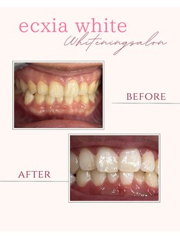 エクシアホワイトニング 奥田店/ホワイトニングビフォーアフター