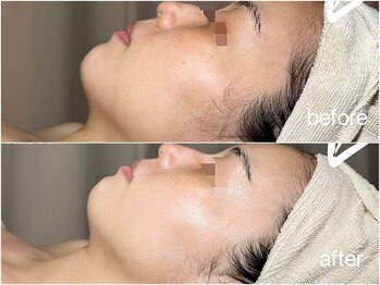 サロン ド ブラン アオヤマ(Salon de BLANC AOYAMA)/クリスティーナ美白ケア