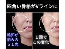 目元 口元のたるみ 眉間シワ改善専門サロン