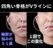 目元 口元のたるみ 眉間シワ改善専門サロン