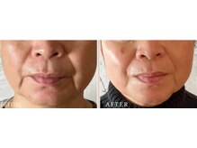 ロジワール(LOISIR)/ほうれい線の印象変化