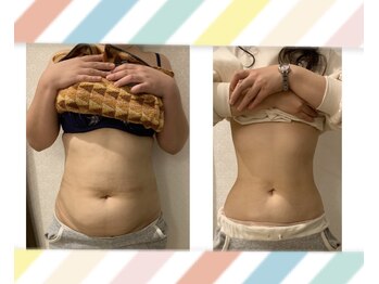 RBD/【熊本/南熊本/脂肪冷却/痩身】