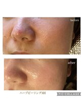 なごみ/毛穴凹凸【ハーブピーリング】