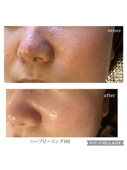 なごみ/毛穴凹凸【ハーブピーリング】