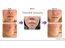 ユアーズ ビューティー(YOURS beauty)/棘あり☆１回