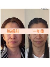 リフェイスフサエ(ReFace Fusae)/たるみ改善シャープな輪郭