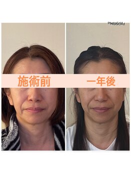 リフェイスフサエ(ReFace Fusae)/たるみ改善シャープな輪郭
