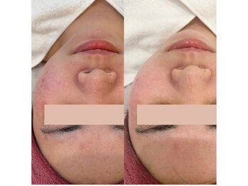 サロンドムーン(salon de MooN)/症例写真