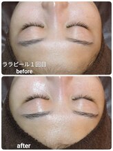 ウララ(ulala)/ララピール１回目