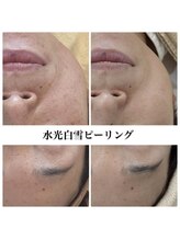 レピア(Le'pia)/水光白雪ピーリング