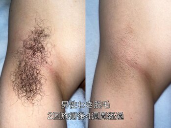 エクレ 柏店(EKURE)/メンズワキ脱毛