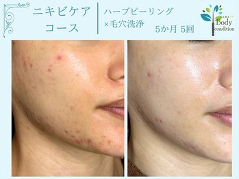 ボディコンディション/ハーブピーリング/毛穴洗浄/小顔