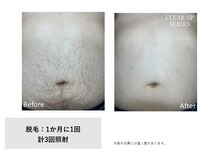 スタンド(STAND)/おなか脱毛