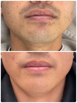 プレジール(PLAISIR)/ヒゲ脱毛