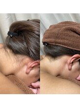 リラチル(relachill)/えりあし脱毛