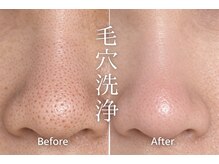 ルージュ(CP Rouge)/40代女性/ダブル毛穴洗浄2回