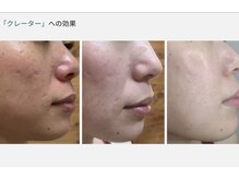 クラティス 伊那店(CRATIS)/ラミネーションピール