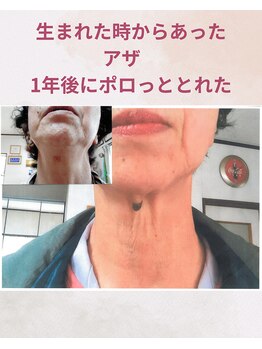 ララスマイル 鶴崎森町店/黒いあざがとれました